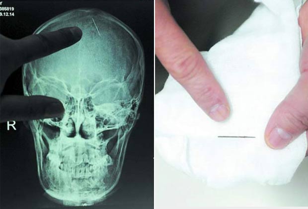 Imagem de raio-X mostra uma agulha de 2,5 centímetros que ficou por 20 encravada na cabeça da chinesa Zhou Chaozheng, que mora na província de Hunan. Ela passou por uma cirurgia em outubro de 2010 após começar a sentir dores de cabeça depois de dar à luz. (Foto: Barcroft Media/Getty Images)
