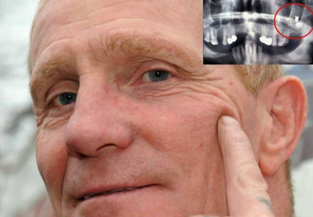 Em 2011, o britânico Tommy Bennett  descobriu após realizar um raio-X que viveu por mais de 40 anos com um chumbinho alojado em sua mandíbula. Bennett, que mora em Washington, na Inglaterra, havia se submetido a exames de rotina antes do tratamento odontológico quando os técnicos descobriram o projétil. (Foto: Reprodução)