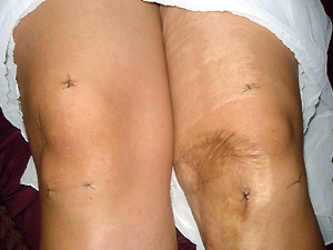 Faxineira teve os dois joelhos operados (Foto: Arquivo pessoal / Maria Aparecida da Silva Corrêa)