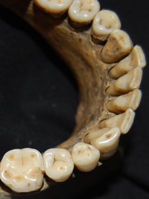 Arcada dentária usada para as pesquisas sobre peste negra. (Foto: Museu de Londres / Divulgação)